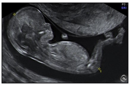 Ecografia de segundo Trimestre
