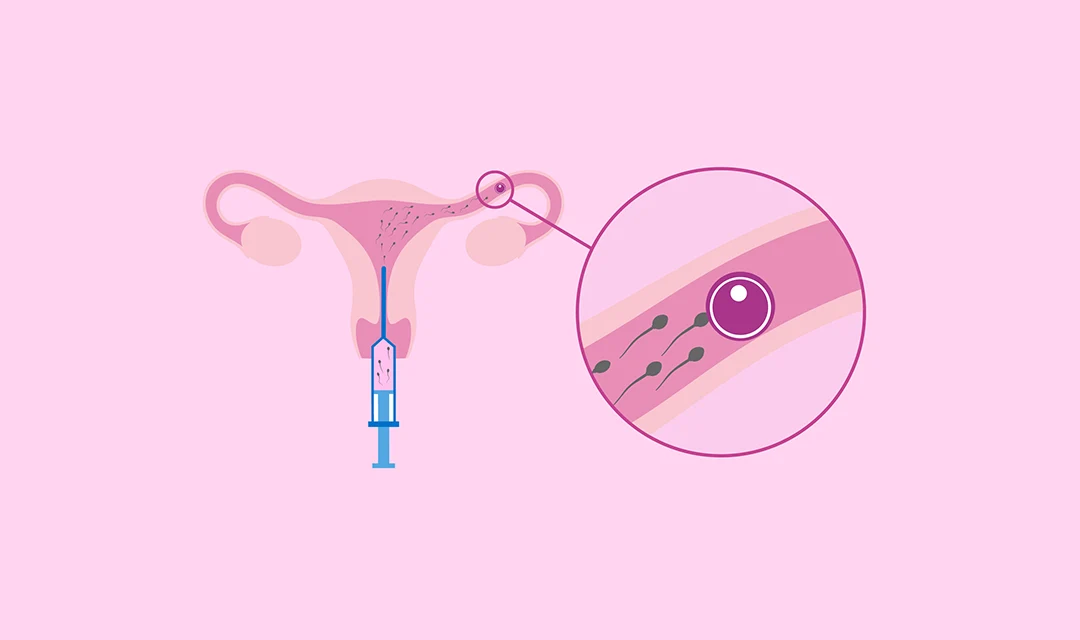 ¿Cuándo está indicada la inseminación artificial?