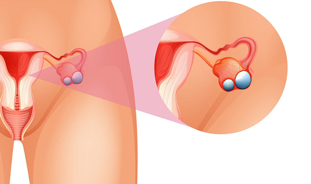 Lo que necesita conocer sobre los quistes ováricos
