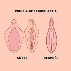 Labioplastia