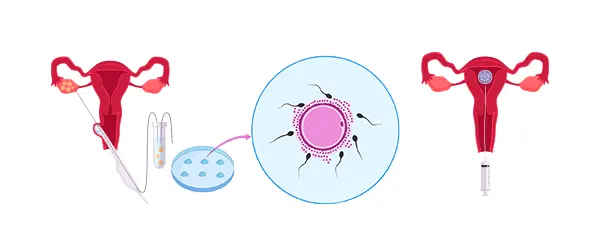 Fertilización in Vitro