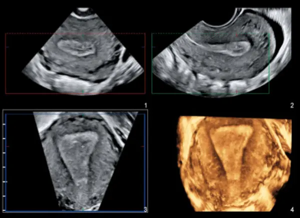 Tipos de ecografía ginecológica
